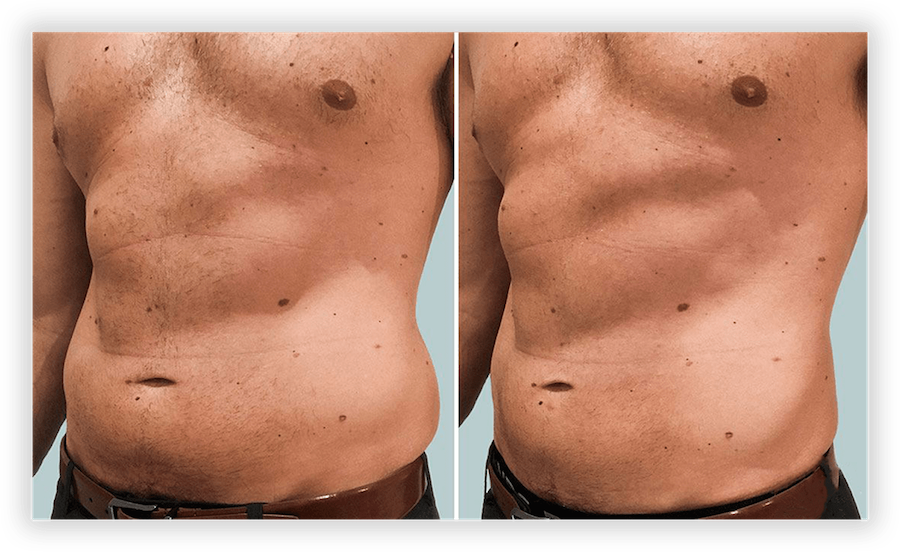 Non Surgical Facelift 2
